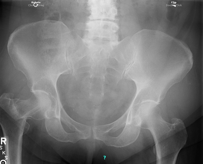 Expert Witness Gilbert AZ Hip X Ray